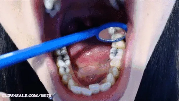 My Dental Filling Fell Out!