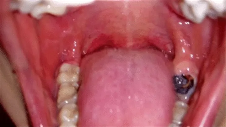 Tonsil stones