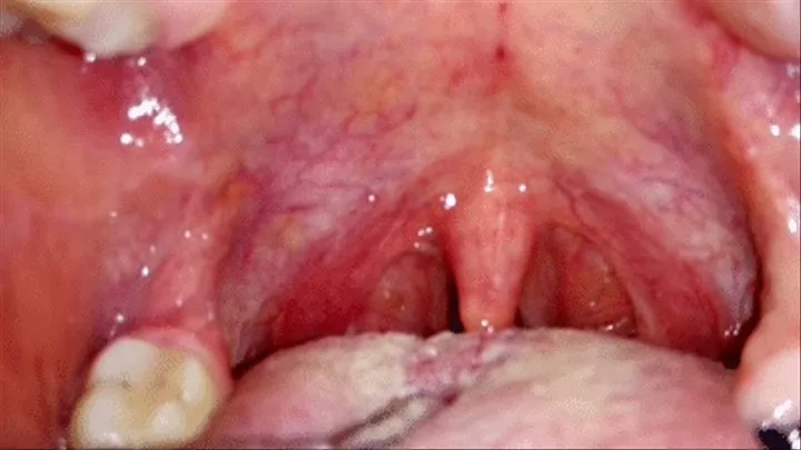 Sick throat and tonsil stones