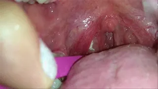 Removing huge tonsil stones