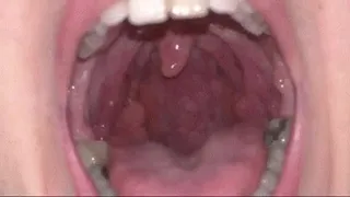 Cleaning the tonsils