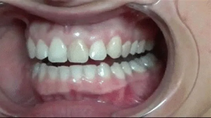 Deep dentition