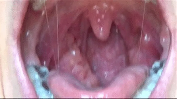 STONE tonsils/