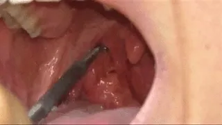 Big tonsils cleaning