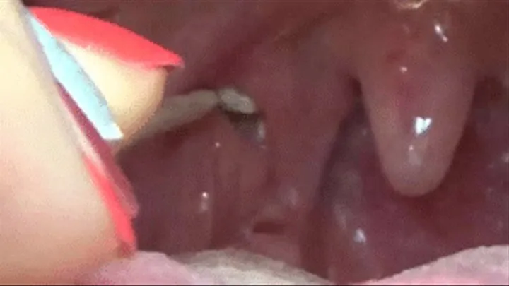 CLEANING tonsil stones!