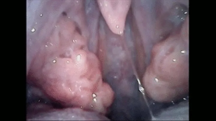 Monstrous tonsils after virus