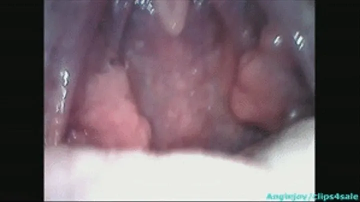 Endoscopy of sperm in the throat