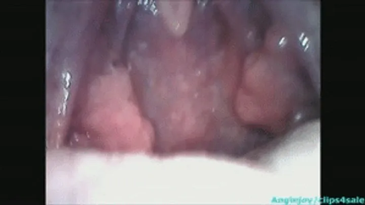 Endoscopy of sperm in the throat