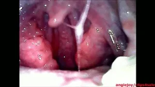 choking phlegm ENDOSCOPY