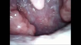 Hiccups endoscopy