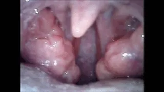 After blowjob, endoscopy