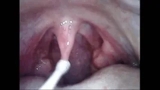 Endoscopic squeezing of stones