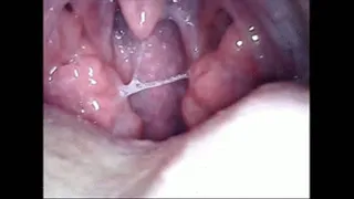 Sick tonsils endoscopy