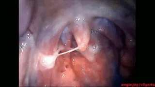 Big phlegm ENDOSCOPY