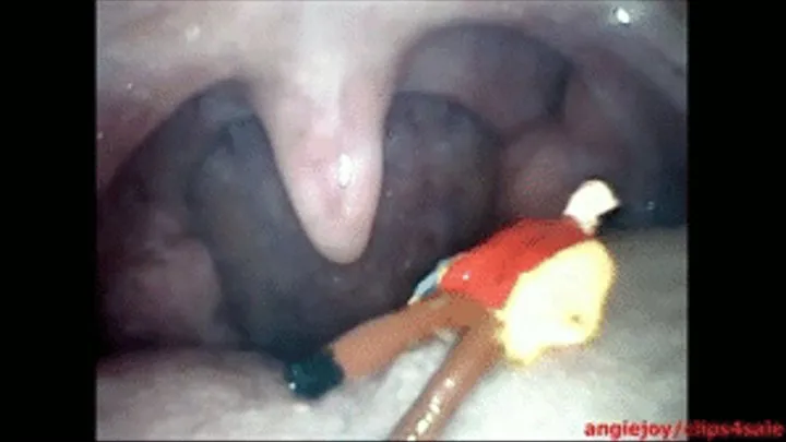 Endoscopic devouring