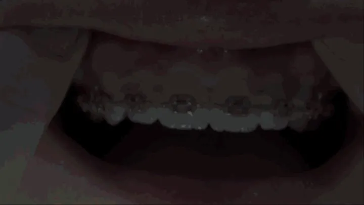 SUPER EXTREME POV BRACES!!!