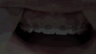 SUPER EXTREME POV BRACES!!!