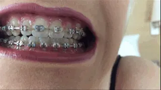 A tour of my braces