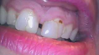 Cleaning dirty teeth full of tartar