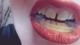 My teeth and my bite