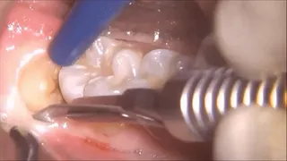 Real tooth pain - At the dentist second part mkv