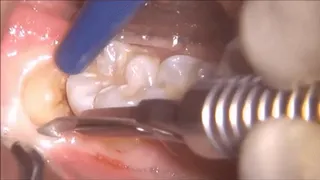 Real tooth pain - At the dentist second part