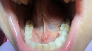 Large tongue salivary calculus