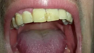No More Cavities!