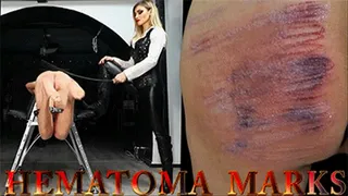 HEMATOMA MARKS