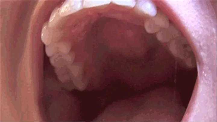 Mouth Exploration: Cavities