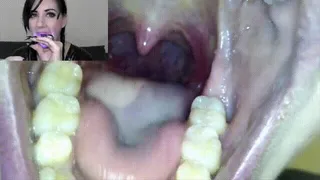 Endoscope mouth tour - Nyxon