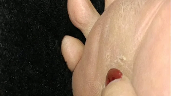 Peeling and clipping blister from ball of foot