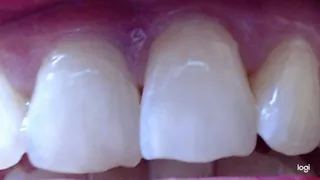5 minutes my nice white teeth in close up