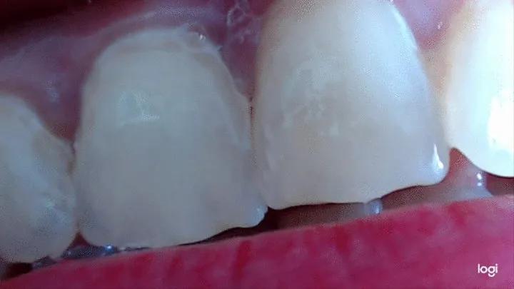 5 minutes of my nice white teeth to cam