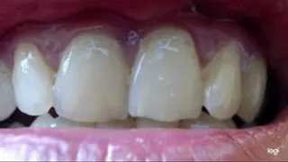17 minutes teeth in close up in various views