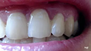 7 minutes nice white teeth to cam in close up