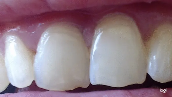 My teeth in new video