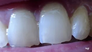6 minutes teeth shiny and white feminine to cam