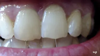8 minutes white teeth and feminine gums to cam