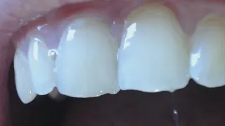 12 minutes teeth in close up on the view with lights