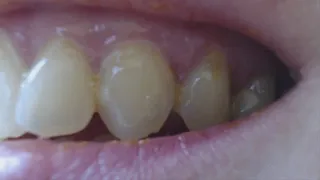 2 minutes showing dirty not clean teeth to cam
