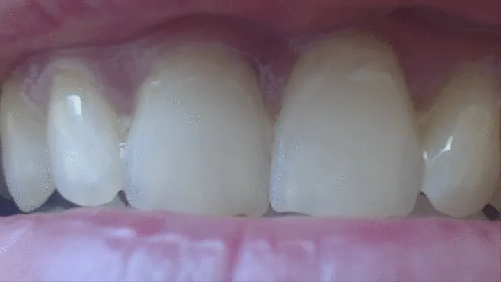 8 minutes my teeth to cam in zoom