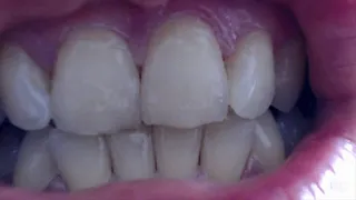 13 minutes of white teeth in close up to cam