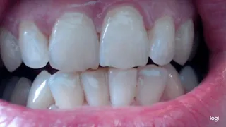 20 minutes of my lovely white teeth to cam