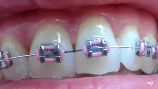 Few minutes of my braces on my top teeth