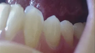 13 min down dental arch with canines