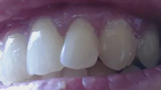 13 minutes with my sharp up canines to cam