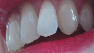 30 minutes teeth to cam after scaling