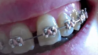 My teeth in brazes to cam