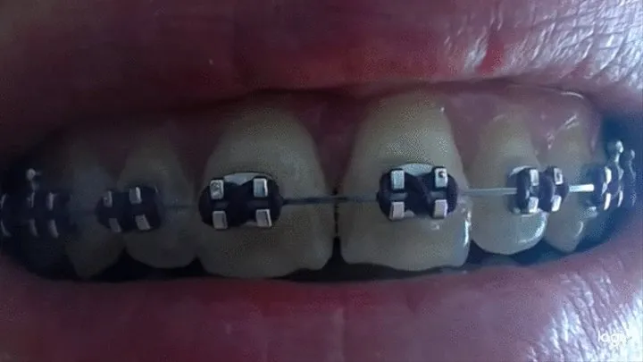 My teeth with braces